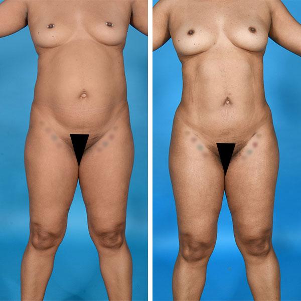 Jeff Lisiecki, MD liposuction result — New York, NY