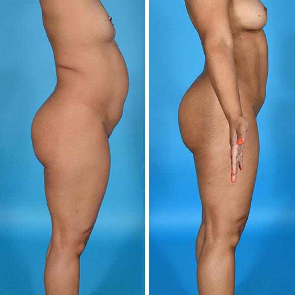 Jeff Lisiecki, MD liposuction result — New York, NY