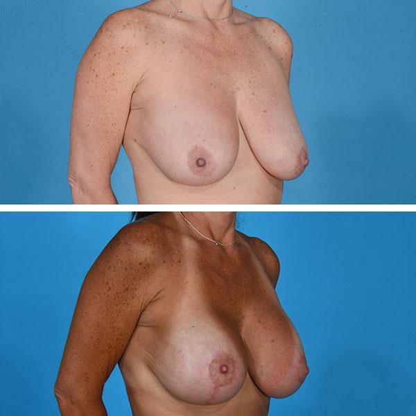 Breast Lift result at Jeff Lisiecki, MD in New York, NY