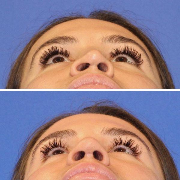 Rhinoplasty result at Jeff Lisiecki, MD in New York, NY