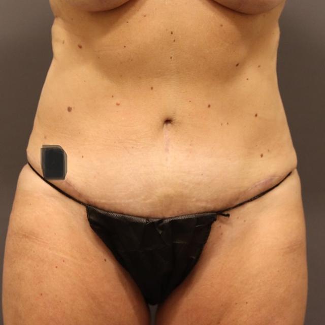 Mini Tummy Tuck after at MD Marion in Lehi, UT
