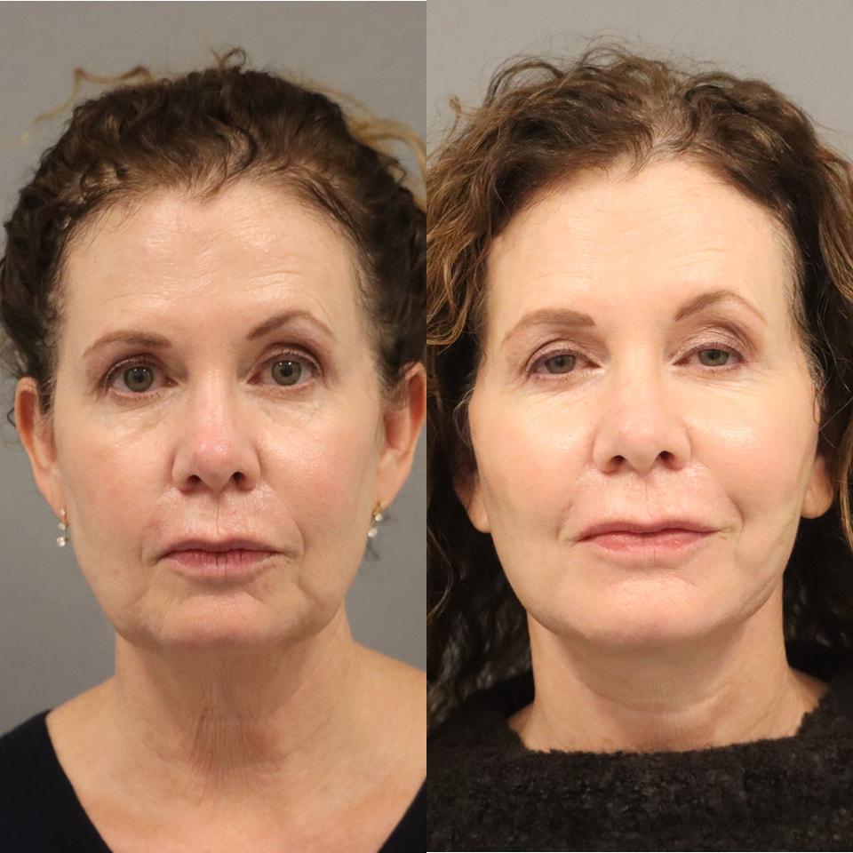 MD Marion facelift result — Lehi, UT
