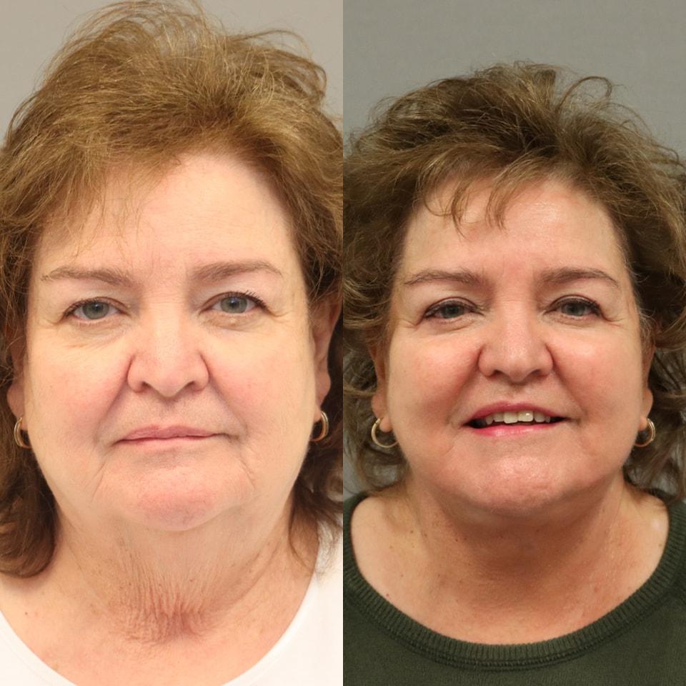 MD Marion neck lift result — Lehi, UT