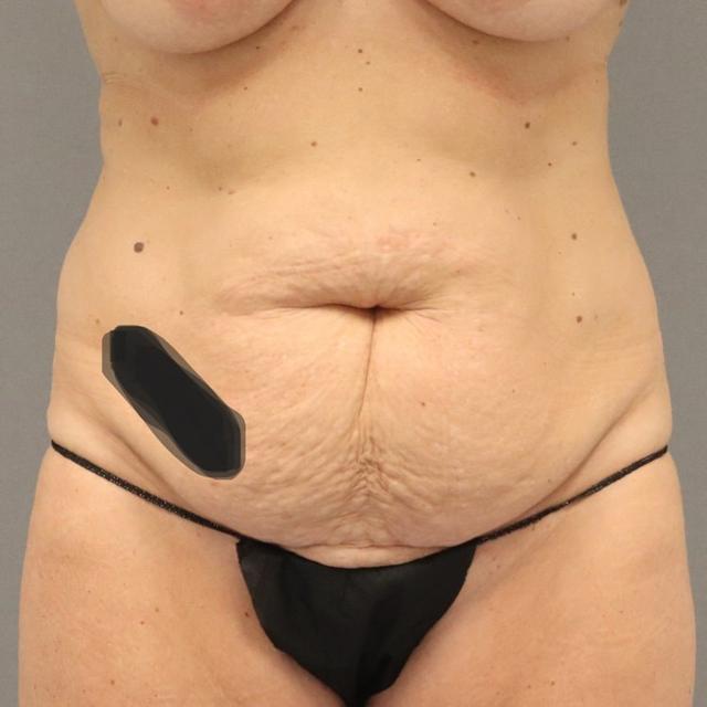Mini Tummy Tuck before at MD Marion in Lehi, UT