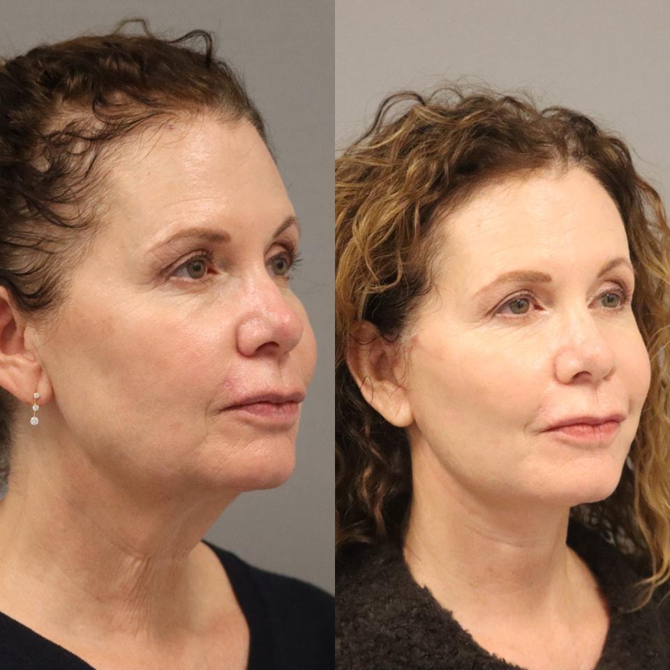 MD Marion facelift result — Lehi, UT