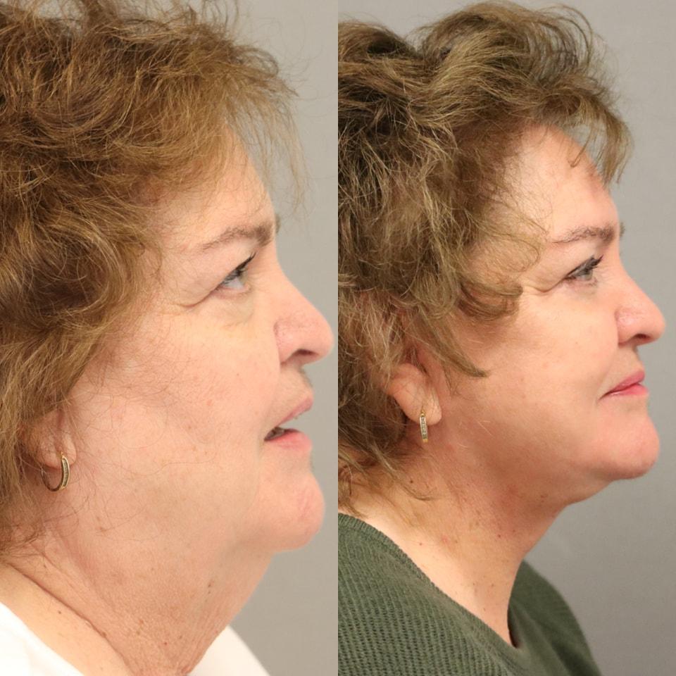 MD Marion neck lift result — Lehi, UT
