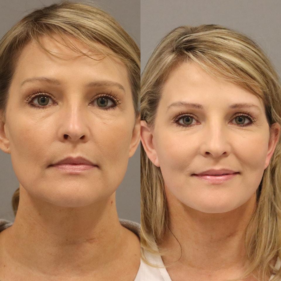 MD Marion facelift result — Lehi, UT