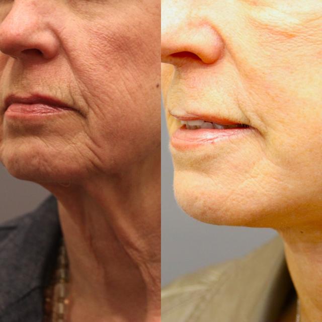 Neck Lift result at MD Marion in Lehi, UT