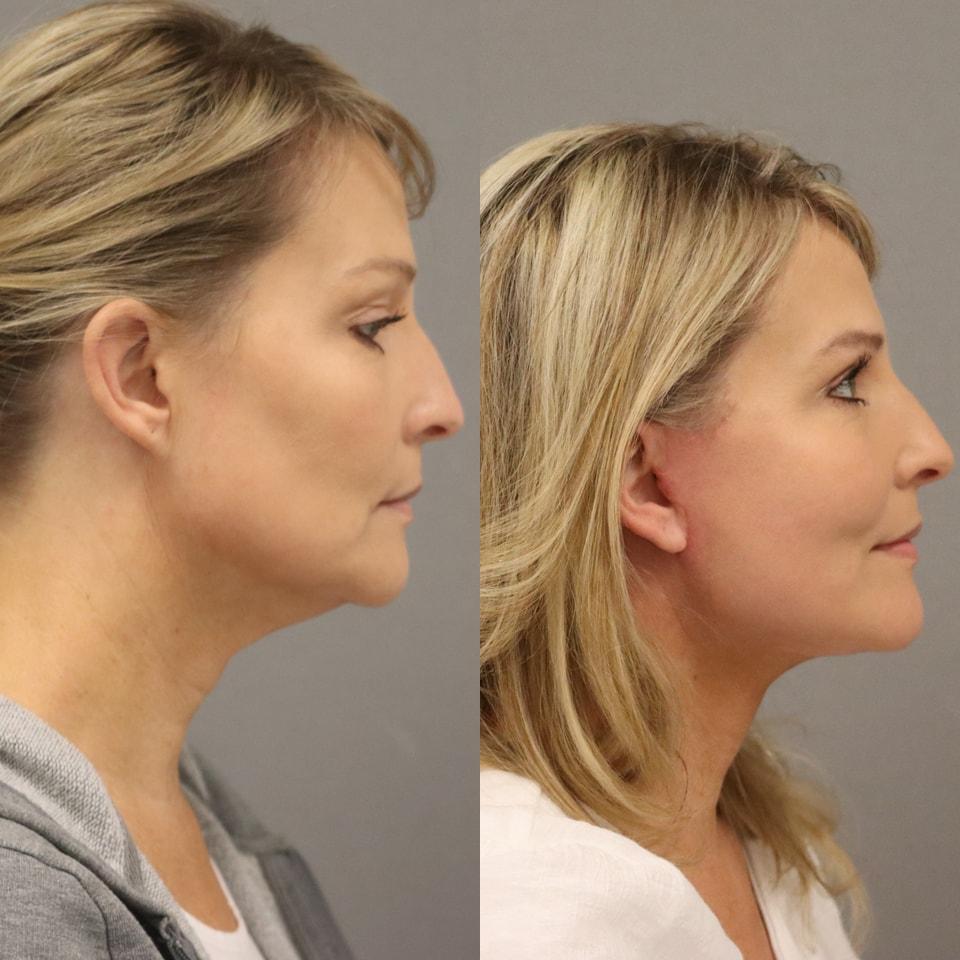 MD Marion facelift result — Lehi, UT