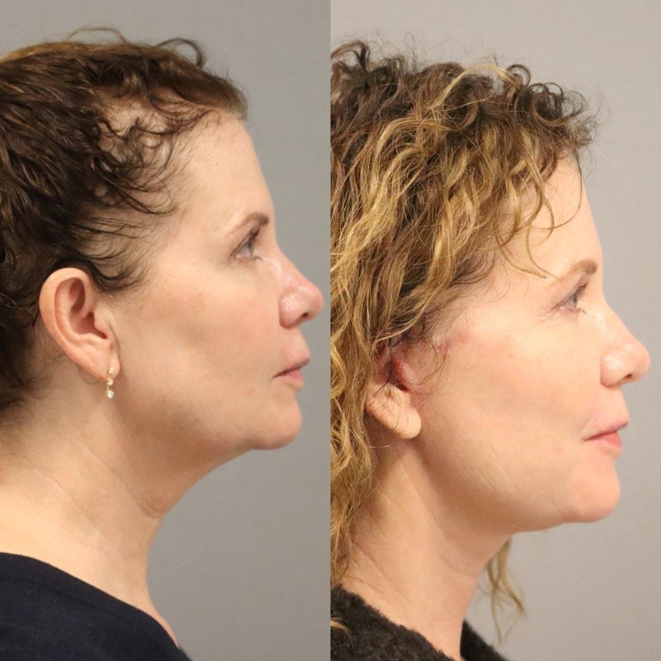 MD Marion facelift result — Lehi, UT