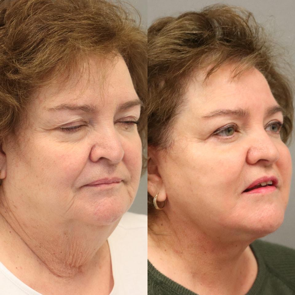 MD Marion neck lift result — Lehi, UT