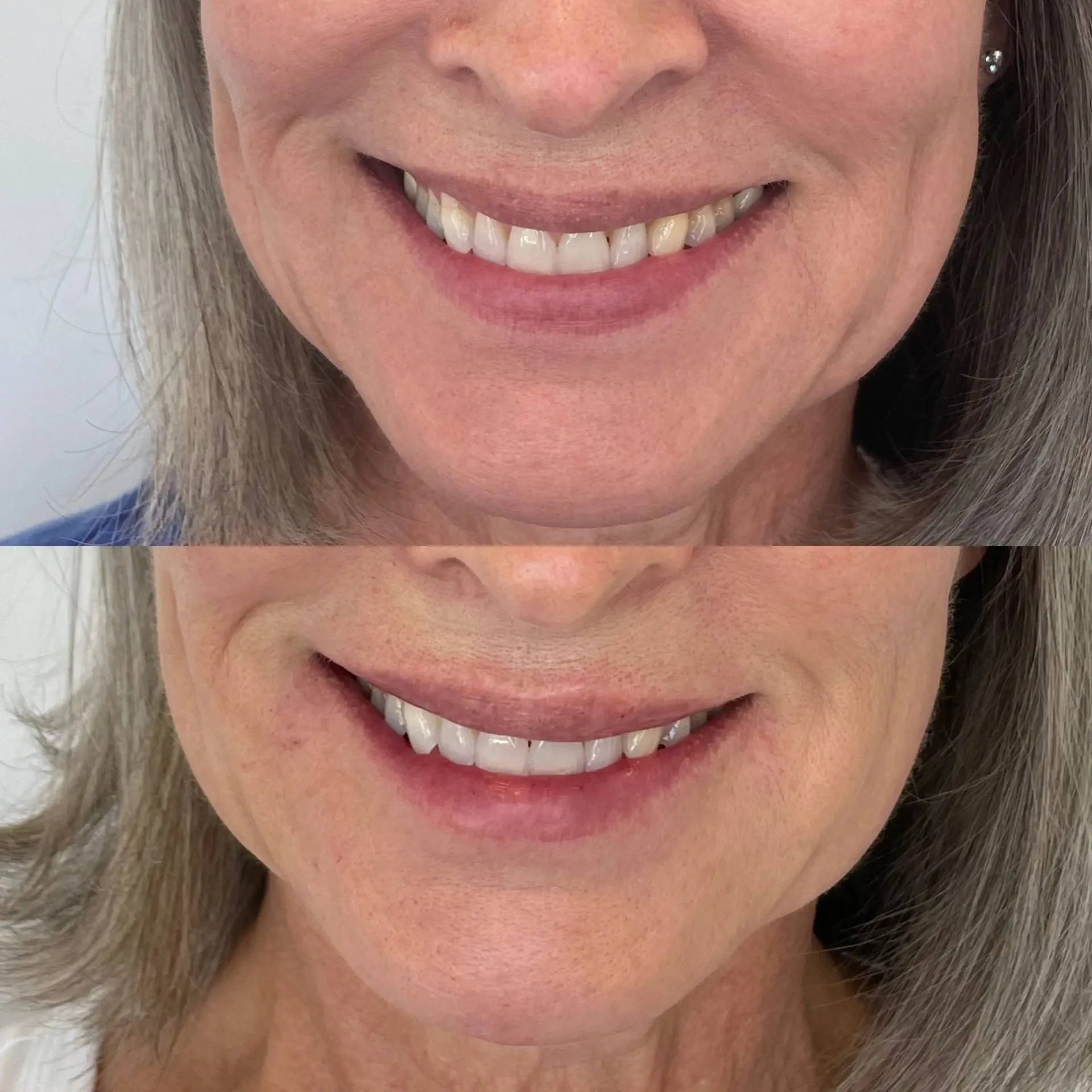 Amrie Aesthetics lip filler result — Provo, UT