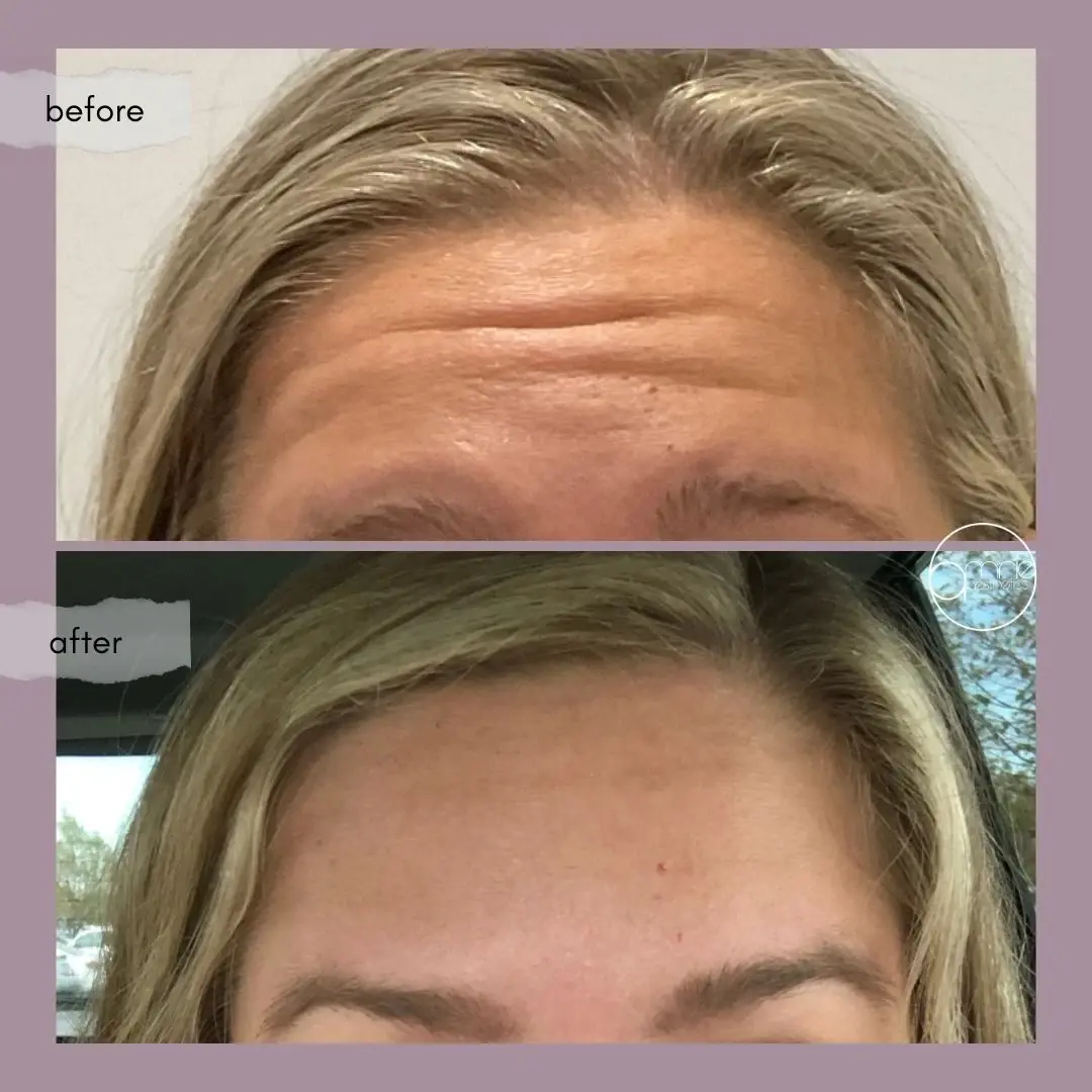 Amrie Aesthetics botox result — Provo, UT