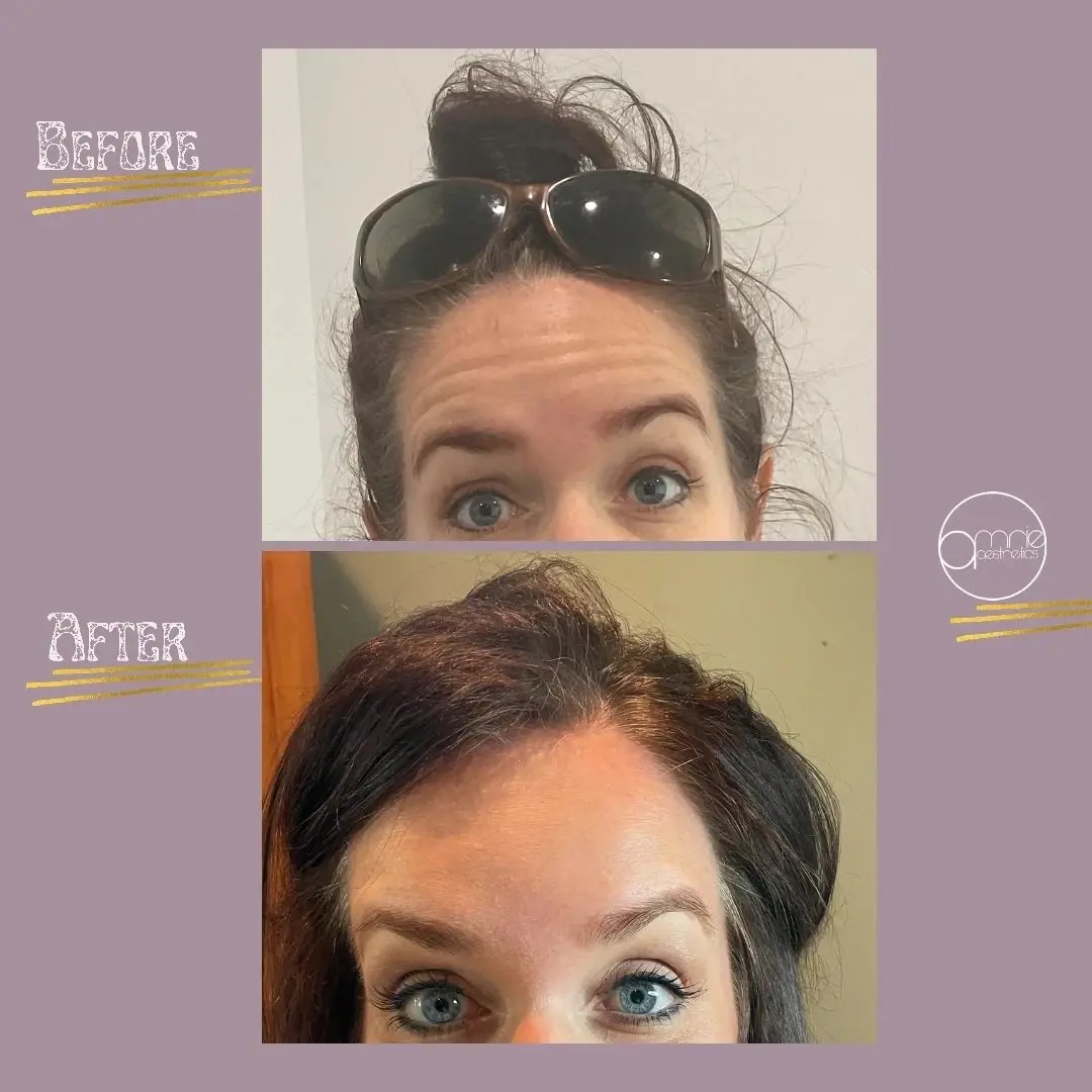 Amrie Aesthetics botox result — Provo, UT