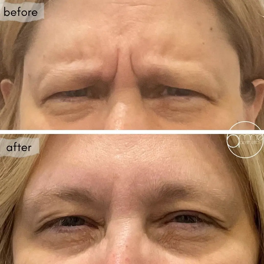 Amrie Aesthetics botox result — Provo, UT