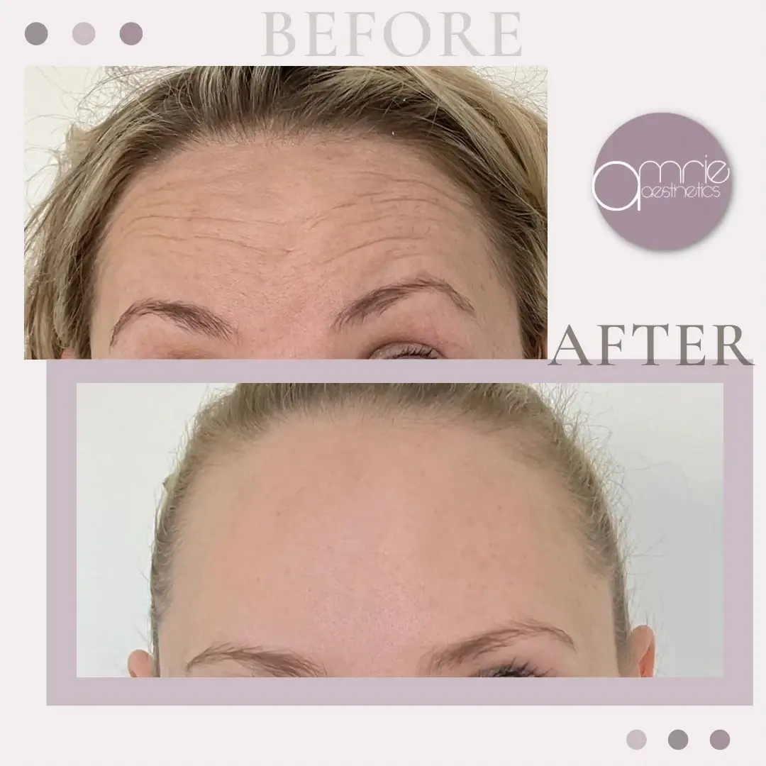Amrie Aesthetics botox result — Provo, UT