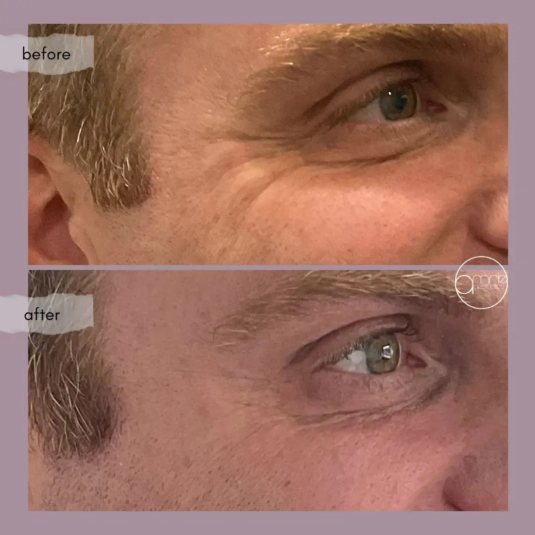 Amrie Aesthetics botox result — Provo, UT