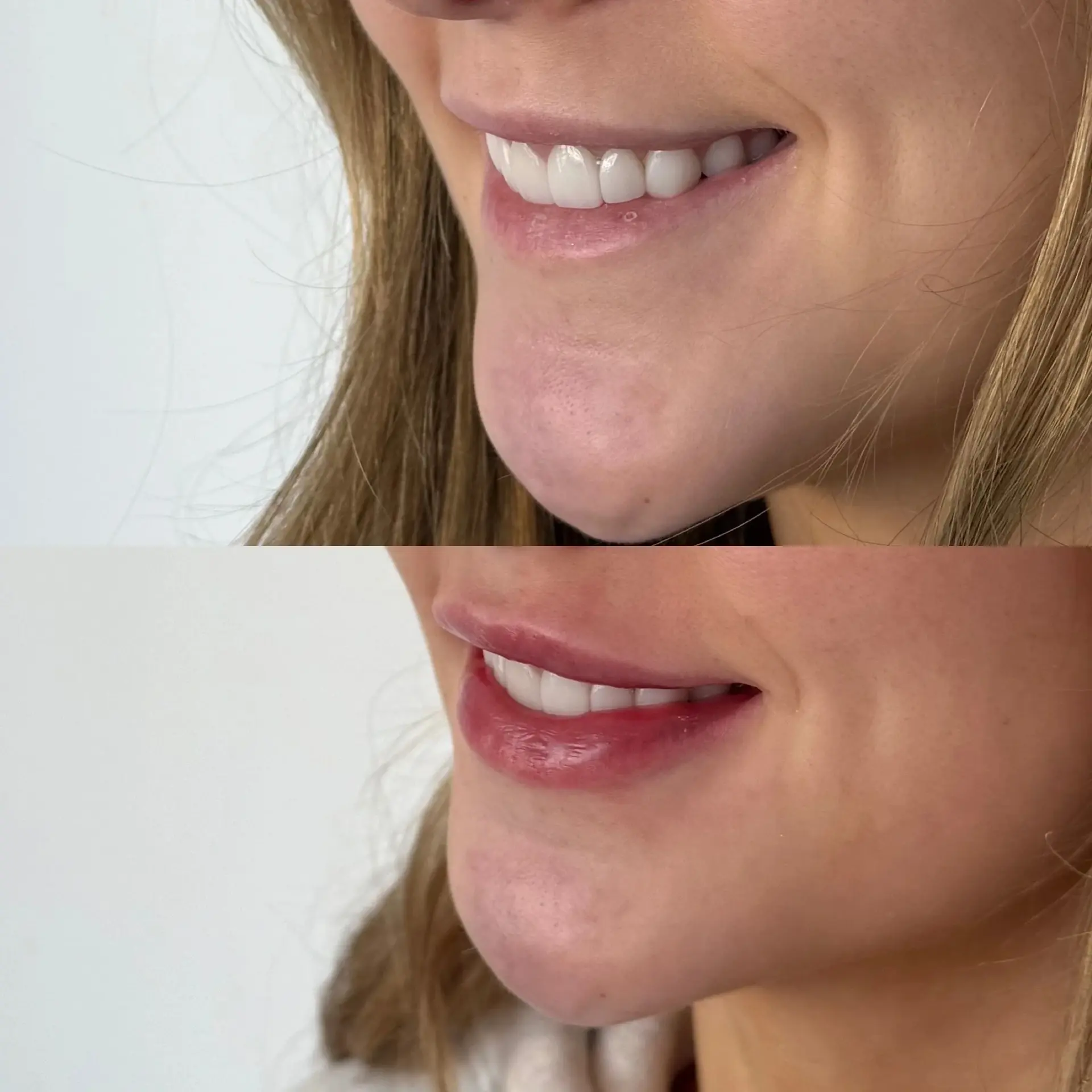 Amrie Aesthetics lip filler result — Provo, UT