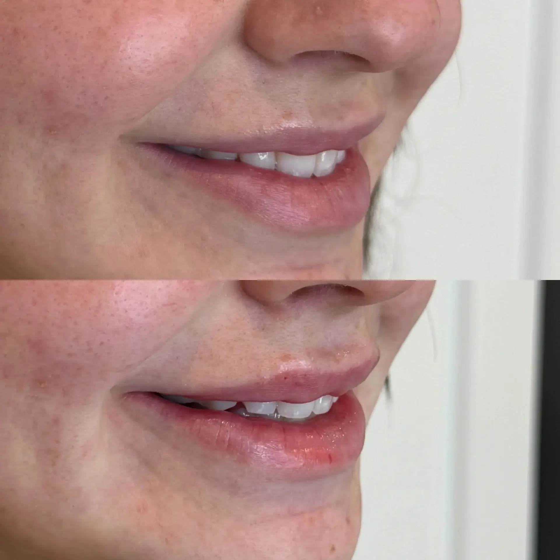Amrie Aesthetics lip filler result — Provo, UT