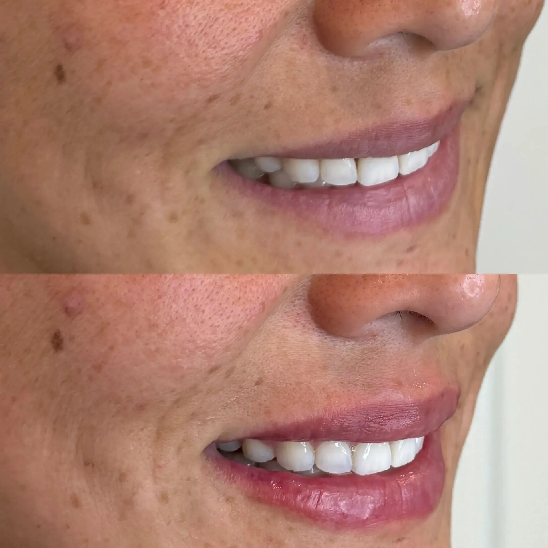 Amrie Aesthetics lip filler result — Provo, UT