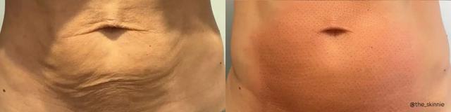 Morpheus8 result at Glow Medical Spa in Franklin, TN