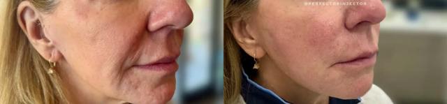 Juvederm result at Glow Medical Spa in Franklin, TN