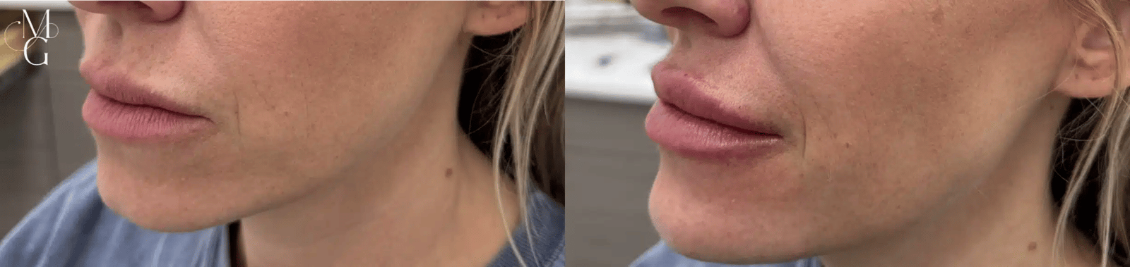 Glow Medical Spa result — Franklin, TN