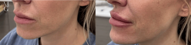 Juvederm result at Glow Medical Spa in Franklin, TN