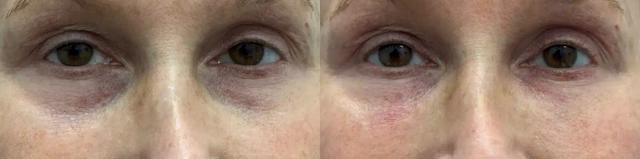 Juvederm result at Glow Medical Spa in Franklin, TN
