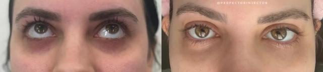 Juvederm result at Glow Medical Spa in Franklin, TN