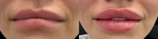 Lip Filler result at Glow Medical Spa in Franklin, TN