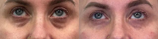 Juvederm result at Glow Medical Spa in Franklin, TN