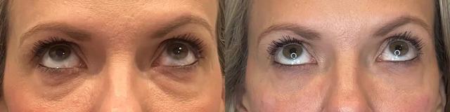 Blepharoplasty result at Glow Medical Spa in Franklin, TN
