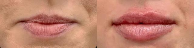 Lip Filler result at Glow Medical Spa in Franklin, TN