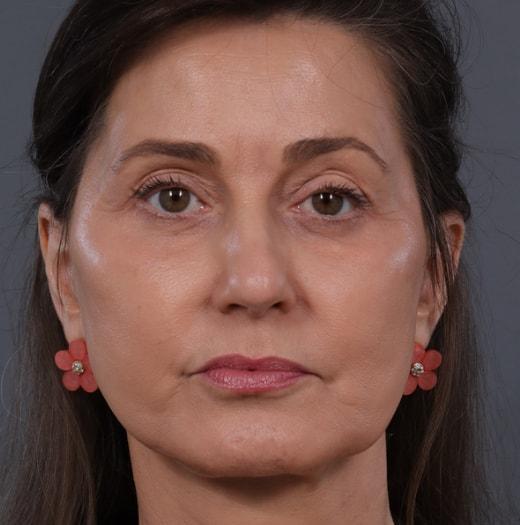 Neck Lift after at JK Plastic Surgery in Frisco, TX