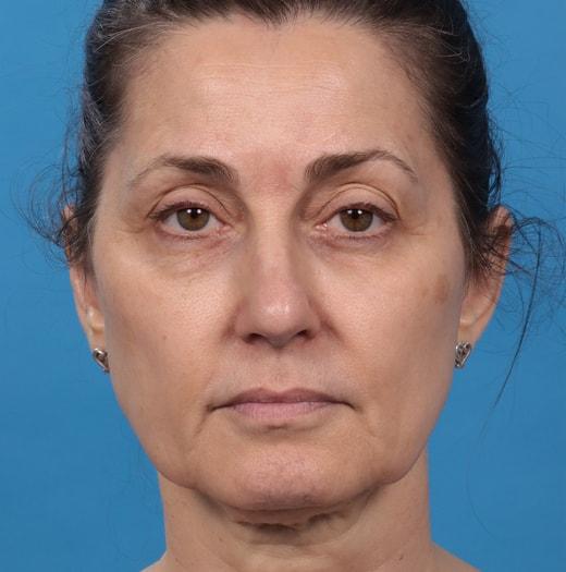 Neck Lift before at JK Plastic Surgery in Frisco, TX