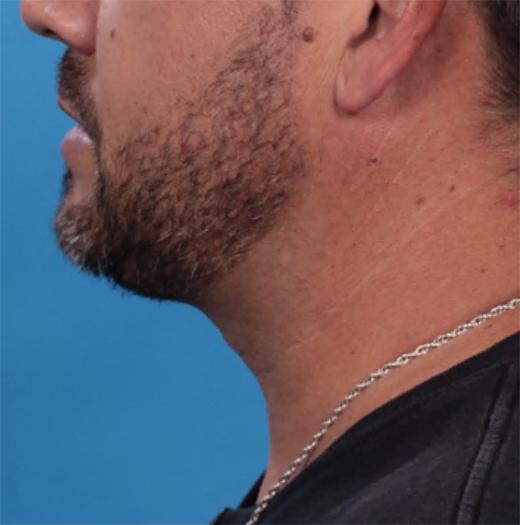 Neck Lift after at JK Plastic Surgery in Frisco, TX