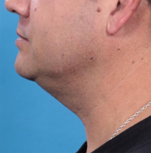 Neck Lift before at JK Plastic Surgery in Frisco, TX