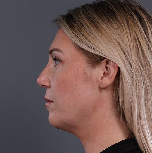 Neck Lift after at JK Plastic Surgery in Frisco, TX