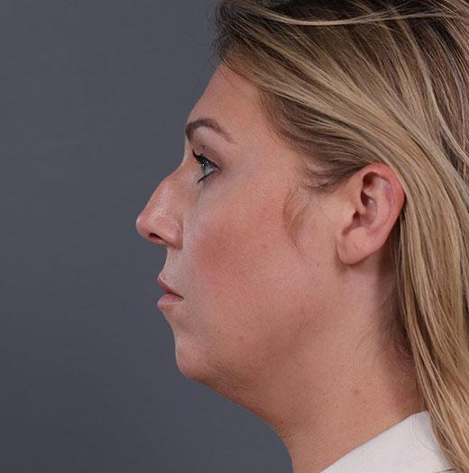 Neck Lift before at JK Plastic Surgery in Frisco, TX