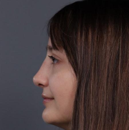 Revision Rhinoplasty after at JK Plastic Surgery in Frisco, TX