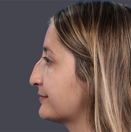 Revision Rhinoplasty before at JK Plastic Surgery in Frisco, TX