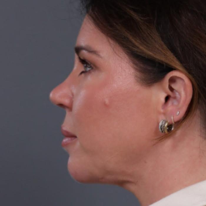 JK Plastic Surgery chin implant after — Frisco, TX