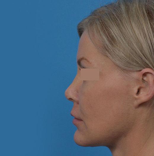 Liquid Rhinoplasty after at JK Plastic Surgery in Frisco, TX