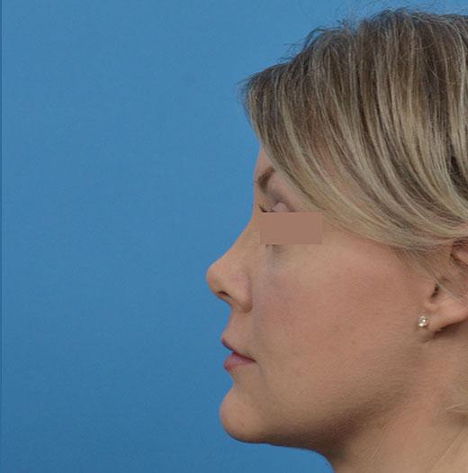 Liquid Rhinoplasty before at JK Plastic Surgery in Frisco, TX