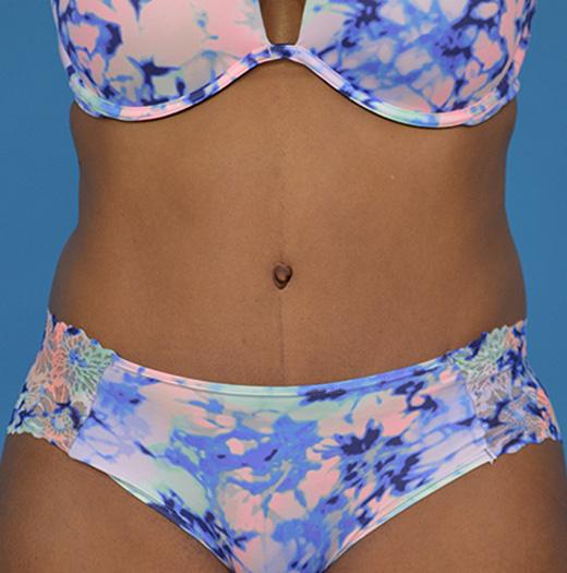 JK Plastic Surgery tummy tuck after — Frisco, TX