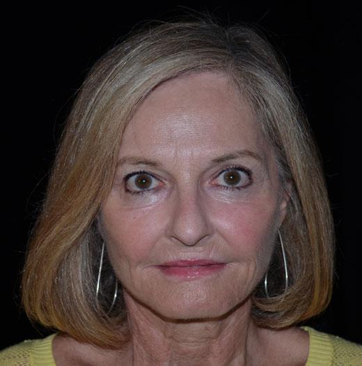 Facelift after at JK Plastic Surgery in Frisco, TX