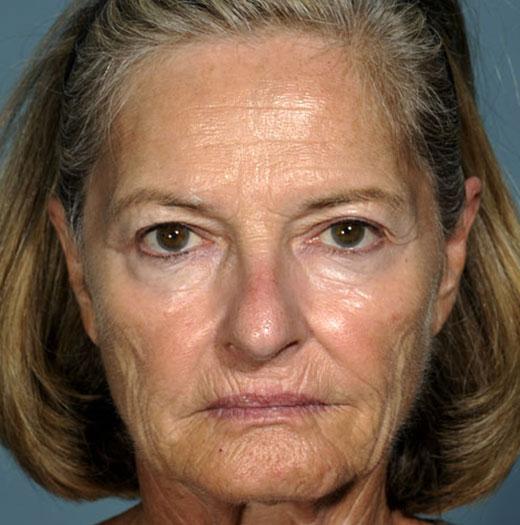 Facelift before at JK Plastic Surgery in Frisco, TX