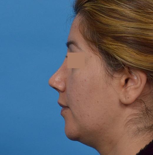 Revision Rhinoplasty after at JK Plastic Surgery in Frisco, TX