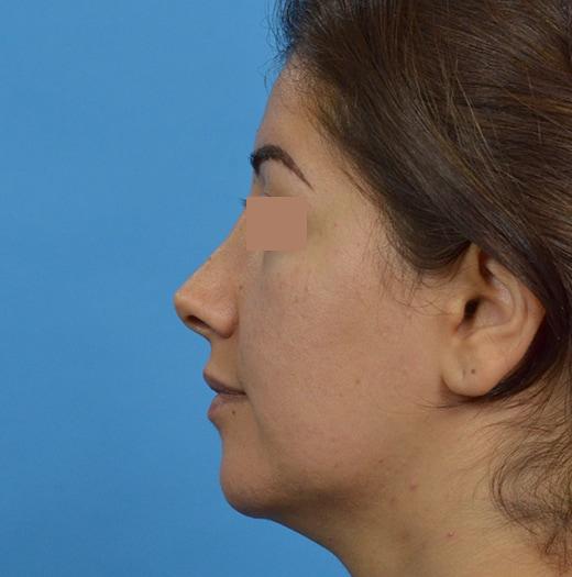 Revision Rhinoplasty before at JK Plastic Surgery in Frisco, TX